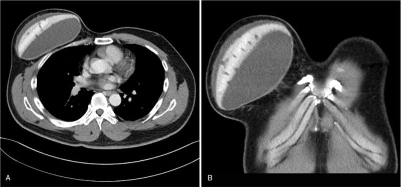 Axial CT and coronal MRI showing a large fluid collection surrounding a chest implant in Poland syndrome.