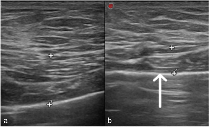 Comparative ultrasound showing normal pectoral muscle on one side and marked pectoral atrophy on the affected side in Poland syndrome.