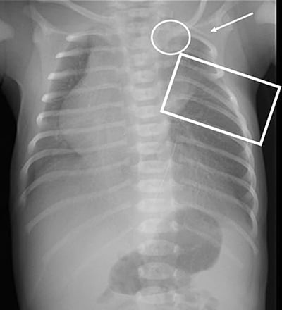 Neonatal AP chest radiograph showing narrowed left intercostal spaces and an apparent cervical rib in atypical Poland syndrome.