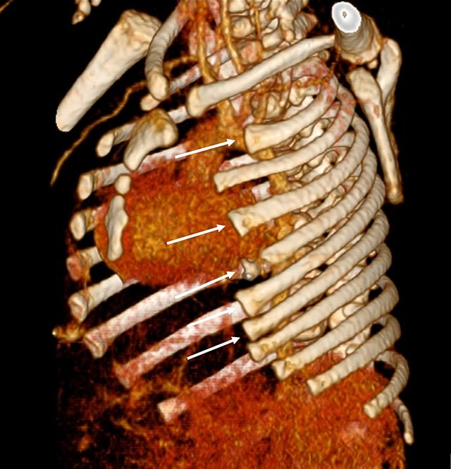 Oblique three-dimensional chest CT showing partial agenesis of multiple left anterior rib arches in Poland syndrome.