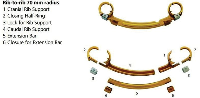 Exploded and assembled views of a vertical expandable prosthetic titanium rib construct with rib supports, locking components and extension bar.