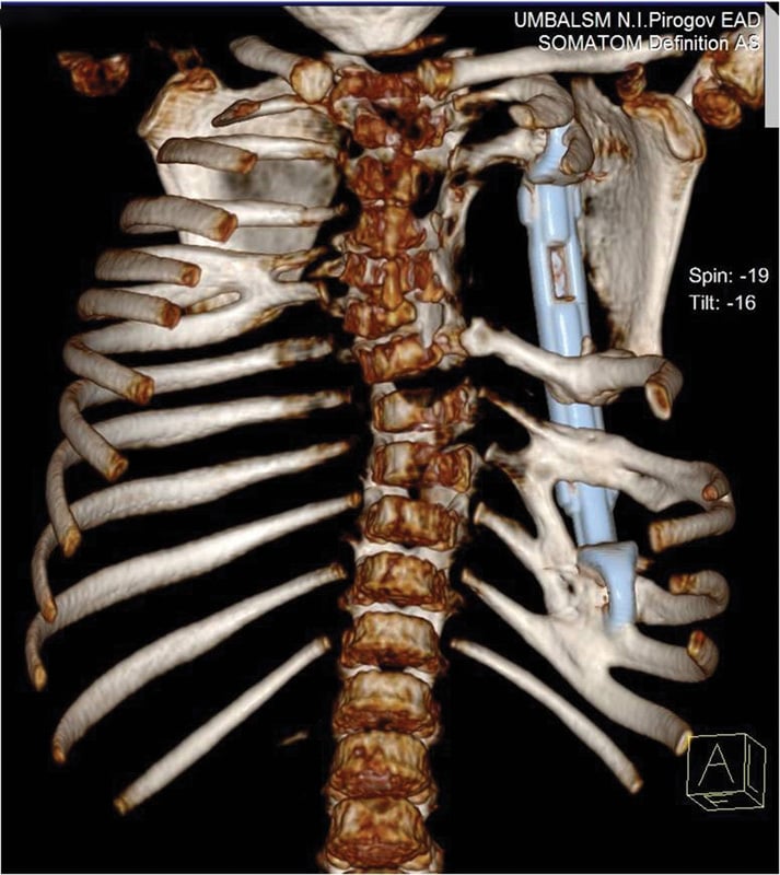 Posterior three-dimensional CT reconstruction showing an expandable rib prosthesis spanning a severe unilateral chest-wall defect in Poland syndrome.