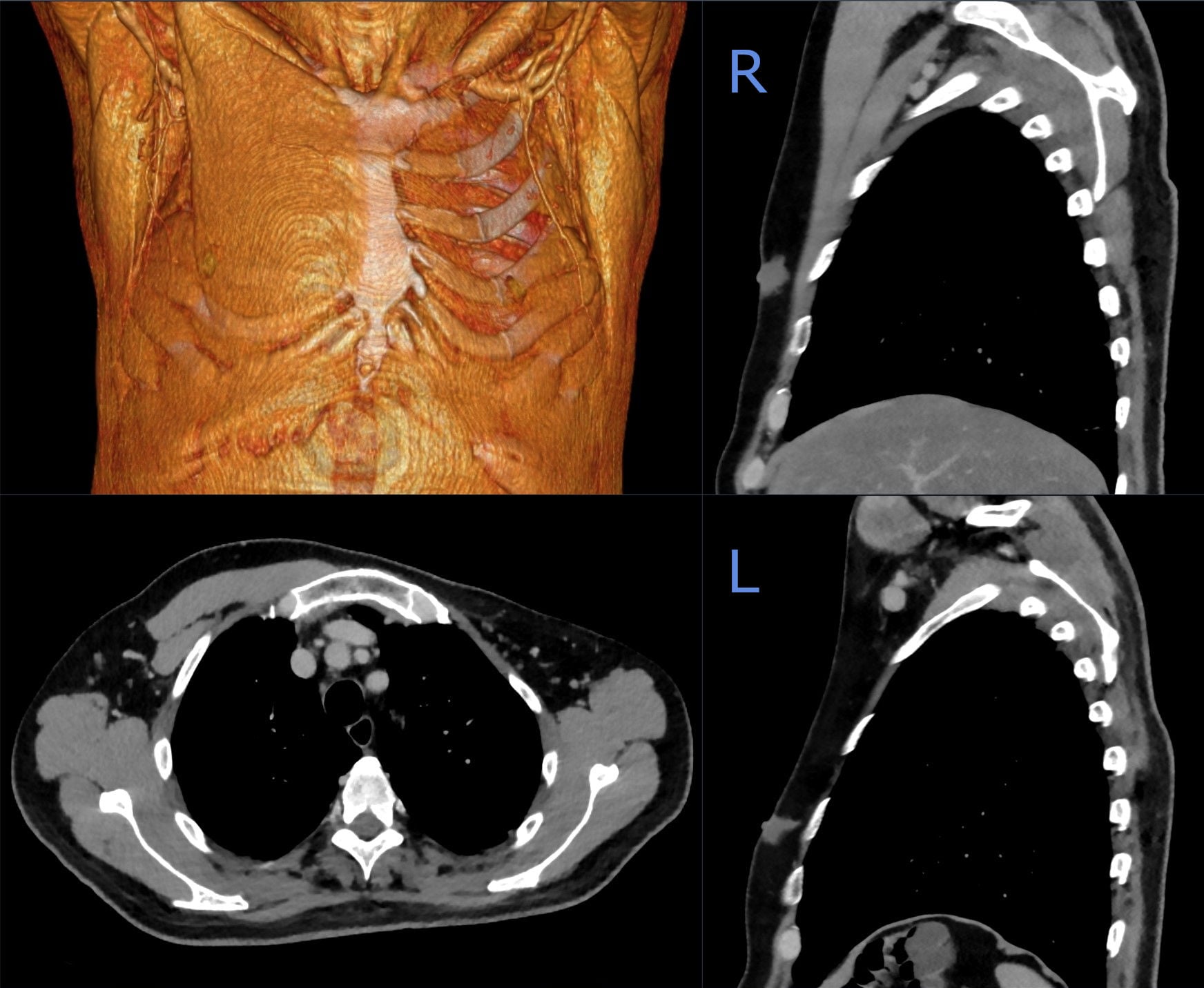 Multi-panel chest CT including a 3D volume-rendered reconstruction, an axial slice and two sagittal reformats labelled R and L, showing asymmetric anterior chest wall musculature in Poland syndrome.