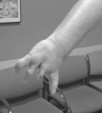 Clinical photograph of a hand in Poland syndrome showing short, tapered digits consistent with symbrachydactyly.