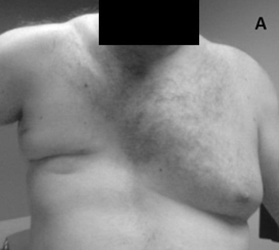 Clinical photograph of an adult male chest in Poland syndrome showing flattening and loss of the normal anterior axillary fold on one side compared with the normal opposite side.