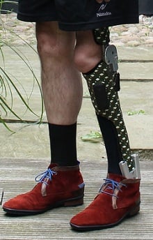 Knee-ankle-foot orthosis on a polio-affected limb illustrating non-operative management