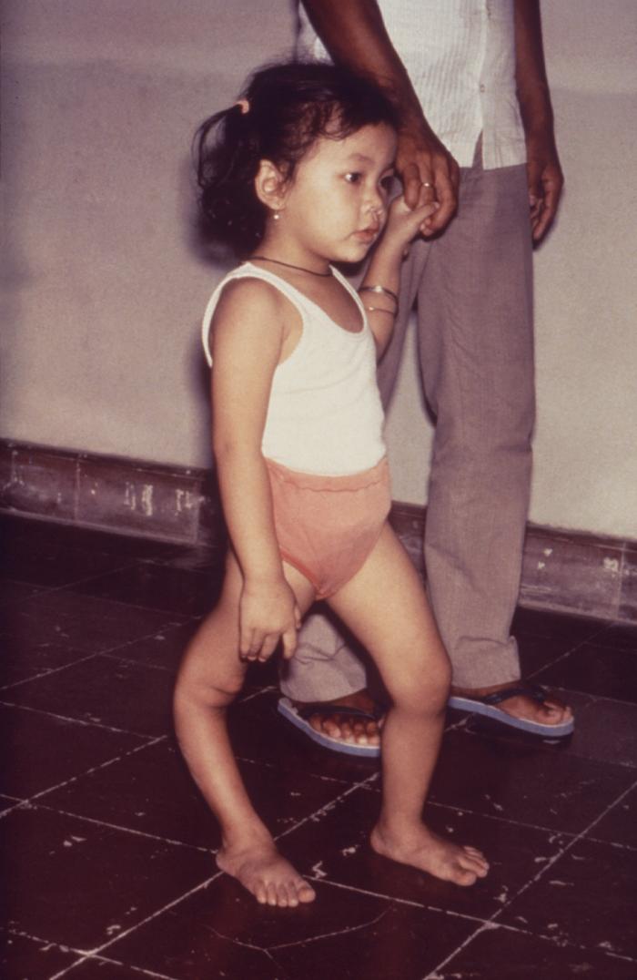 Young child standing with one visibly thinner and shorter lower limb after paralytic polio
