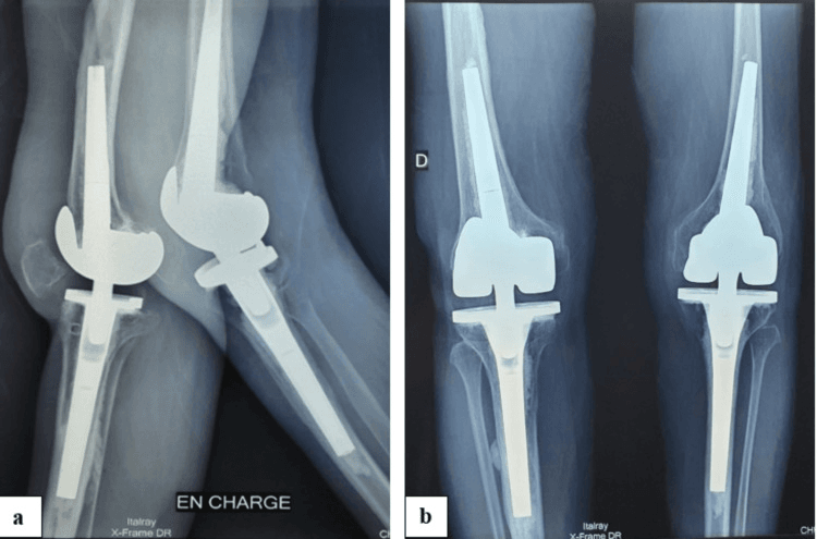 Six-month radiographs after bilateral total knee replacement in polio