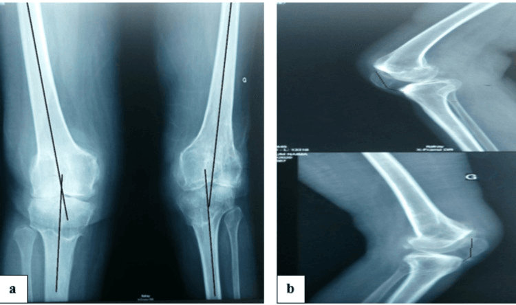 Severe bilateral valgus knees with patella baja before arthroplasty in poliomyelitis