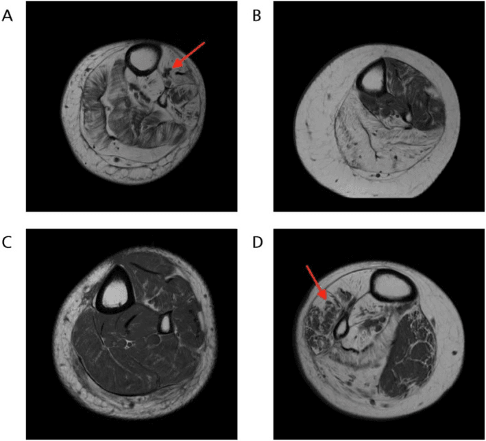 T1 MRI showing patchy fatty replacement in post-polio calf muscles