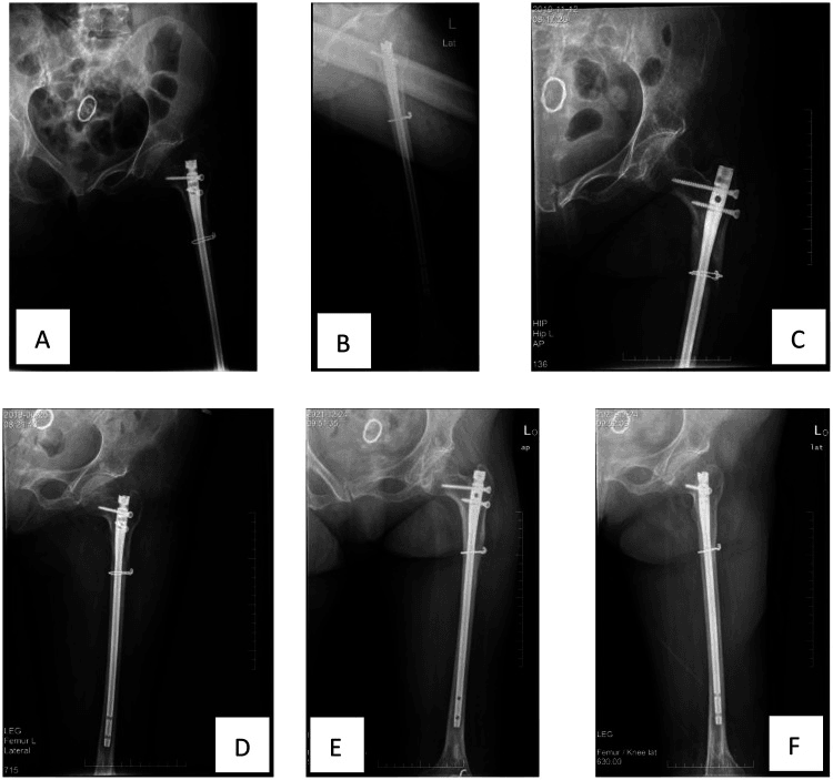 Serial union after adapted intramedullary fixation of a post-polio femur