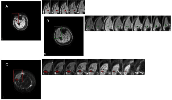 Sequential MRI profiles of enlarged post-polio motor units
