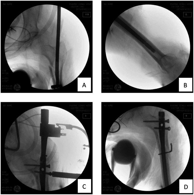 Narrow-canal subtrochanteric fracture fixation in a polio-affected femur