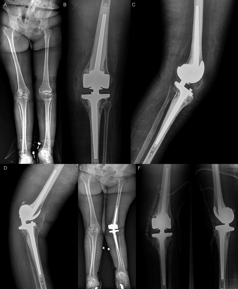 Radiographic recurrence of knee hyperextension after rotating-hinge arthroplasty in polio