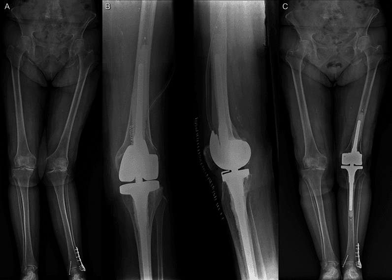 Rotating-hinge knee arthroplasty for severe valgus deformity after polio
