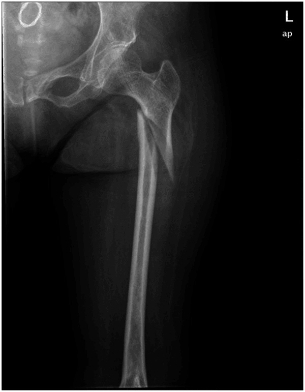 Subtrochanteric fracture through a polio-affected femur