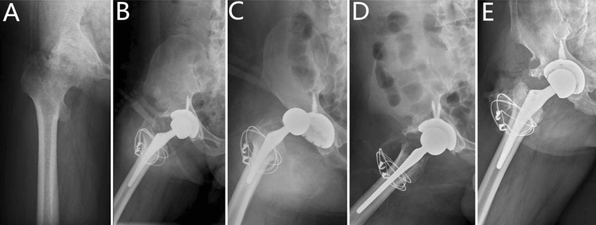 Hip arthroplasty dislocation and reduction in residual poliomyelitis