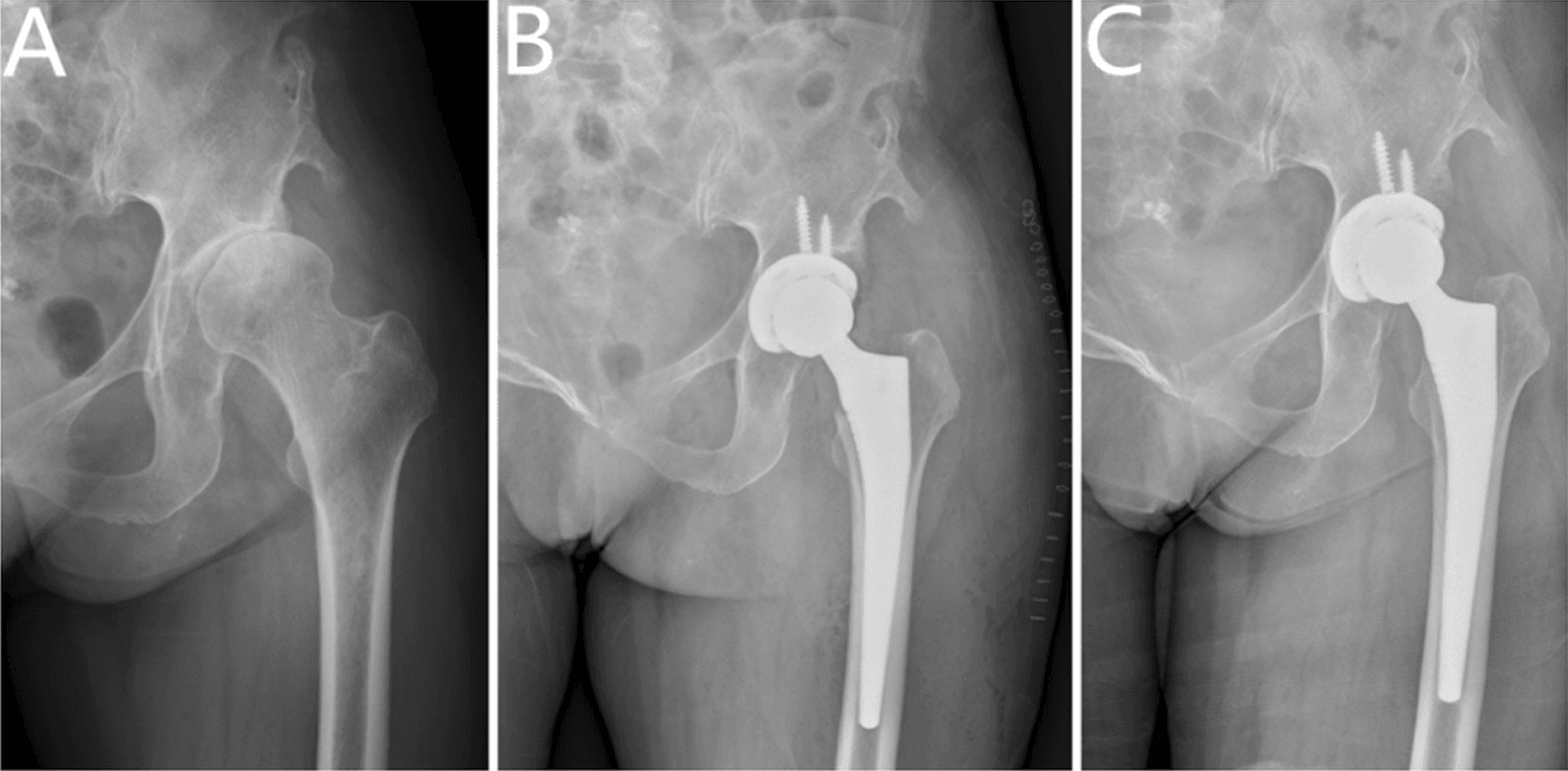 Hip arthroplasty for dysplastic osteoarthritis in residual poliomyelitis