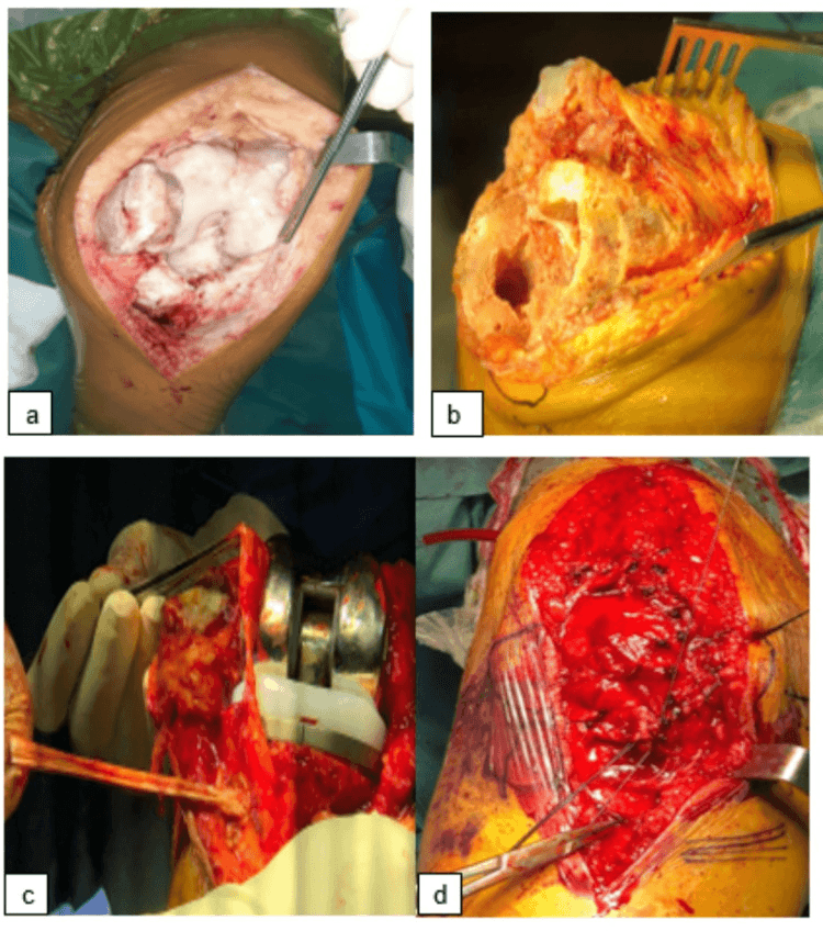 Extensor-mechanism lengthening during total knee replacement in polio