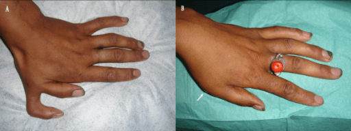 Two clinical hand photographs showing left preaxial thumb duplication before and after excision