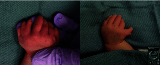 Clinical photographs of both infant hands with ulnar postaxial polysyndactyly