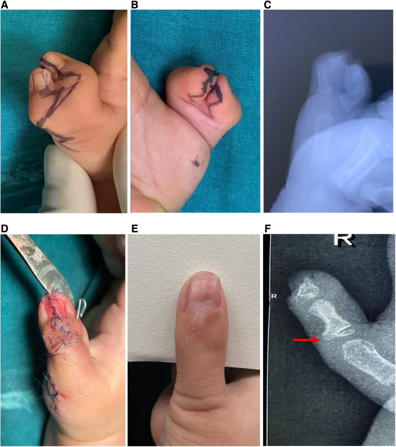 Six-panel series showing incision design, preoperative radiograph, modified Bilhaut reconstruction and 15-month clinical and radiographic outcome