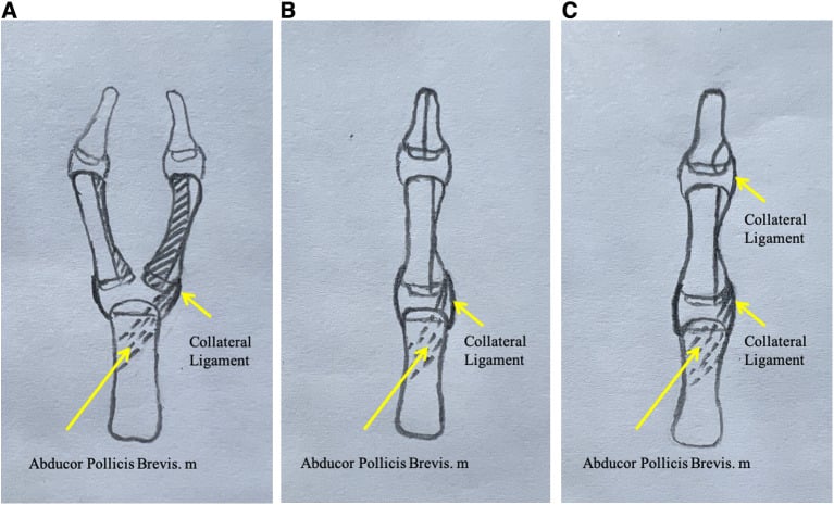 Three-panel modified Bilhaut-Cloquet schematic showing proximal and distal phalangeal osteotomies with collateral ligament and abductor pollicis brevis preservation
