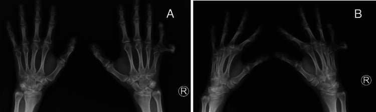 Bilateral hand radiographs in AP and oblique views showing unilateral postaxial polydactyly with a metacarpal delta phalanx