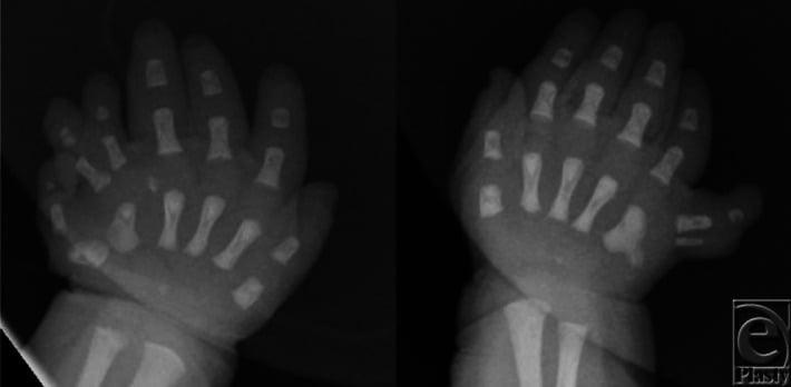 Anteroposterior radiographs of both infant hands showing bilateral postaxial polysyndactyly