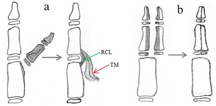 Schematic comparing excision with radial collateral ligament and thenar reconstruction against Bilhaut-Cloquet combination reconstruction