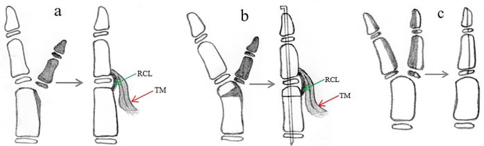 Three reconstruction schematics for an angulated thumb duplicate showing ligament reconstruction, corrective osteotomy and combination reconstruction