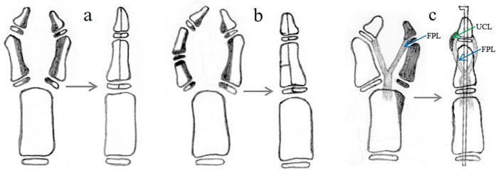 Three schematics for convergent thumb duplication showing Bilhaut combinations and excision with UCL and FPL reconstruction