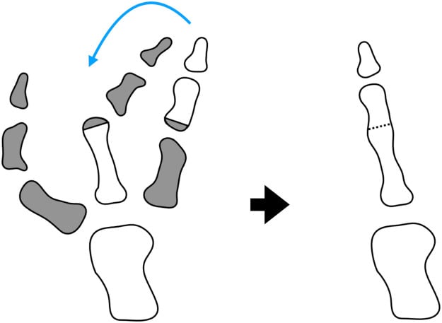 On-top plasty schematic showing selected phalangeal segments from three thumb rays assembled into one reconstructed thumb