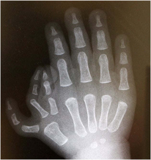 Paediatric hand radiograph showing three triphalangeal thumb rays