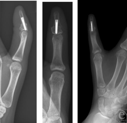 Postoperative AP and lateral thumb radiographs showing corrective osteotomy of a triphalangeal thumb fixed with a headless compression screw