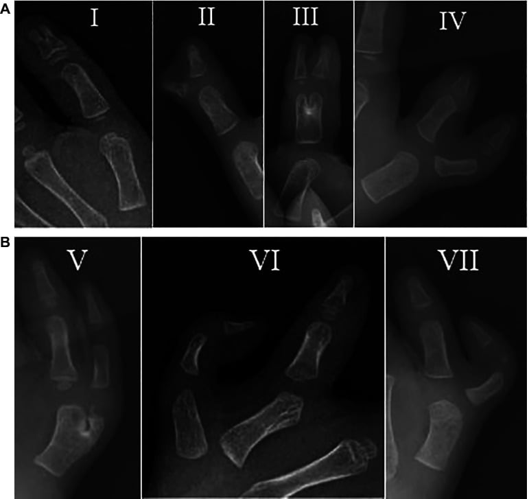 Seven paediatric thumb radiographs demonstrating Wassel-Flatt types I through VII