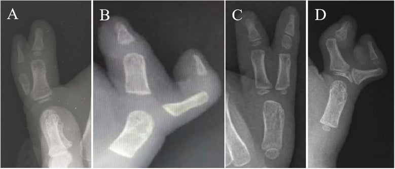 Four radiographs showing hypoplastic, ulnar-deviation, divergent and convergent Wassel IV thumb-duplication subtypes