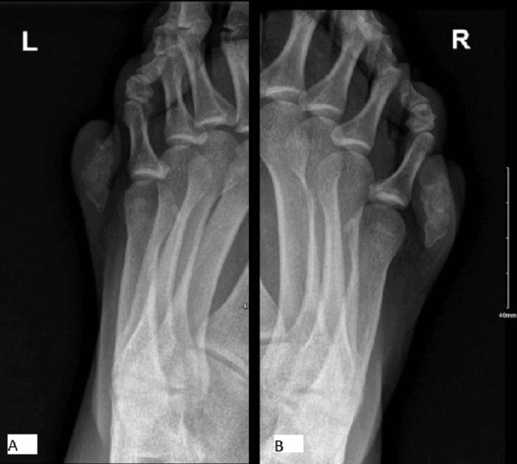 Bilateral AP foot radiographs, panel A left foot and panel B right foot with a 40 mm scale bar, each with a lateral extra digit containing an ossicle