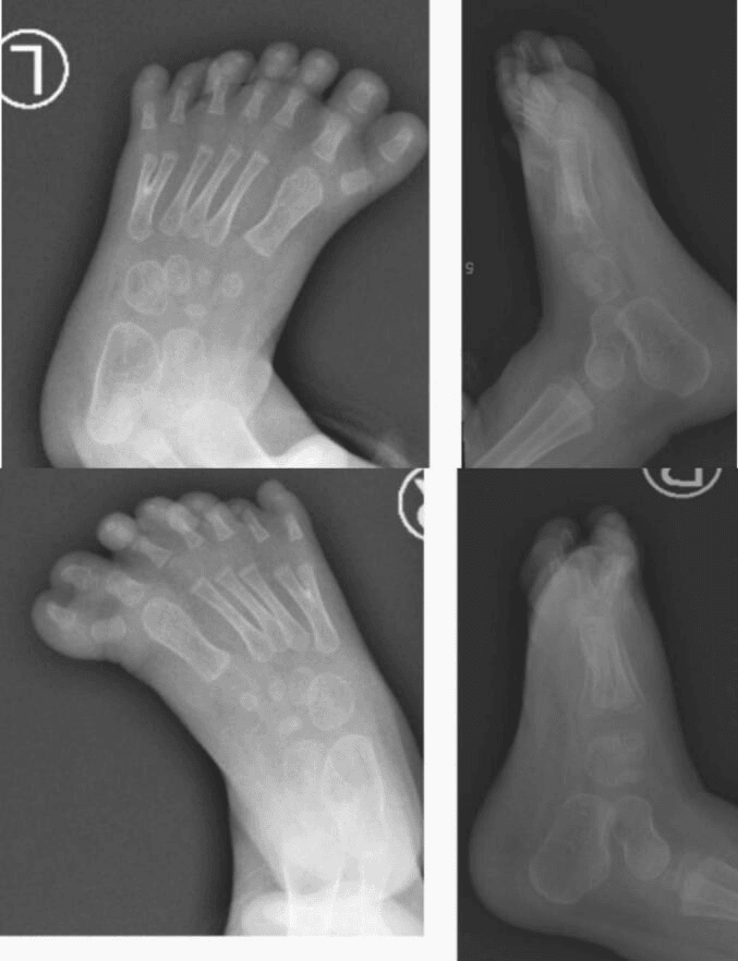AP and lateral radiographs of both feet of an infant, each foot with a bifid fifth metatarsal laterally and two great toes on a broad first metatarsal medially