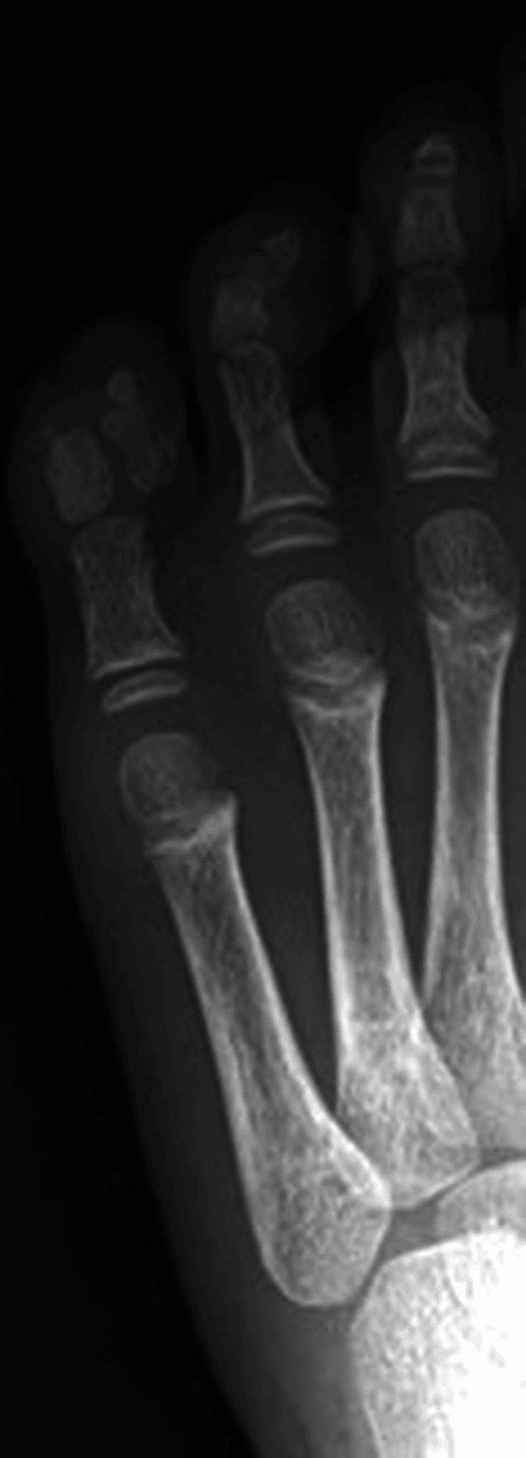 AP radiograph of the lateral forefoot rays, with two ossicles side by side at the tip of the outermost toe
