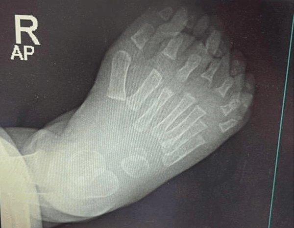 Infant AP radiograph of the right foot (markers R and AP) showing combined preaxial and postaxial polydactyly with more than five metatarsals