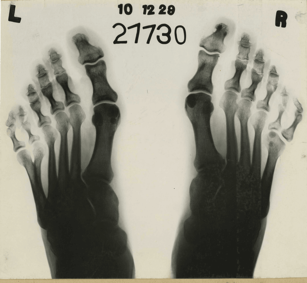 Historical radiograph of both feet, markers L and R, each foot with six toes and the extra toe on the lateral border