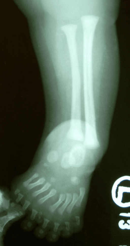 AP lower-leg and foot radiograph showing fibular duplication with multiple metatarsals in mirror foot