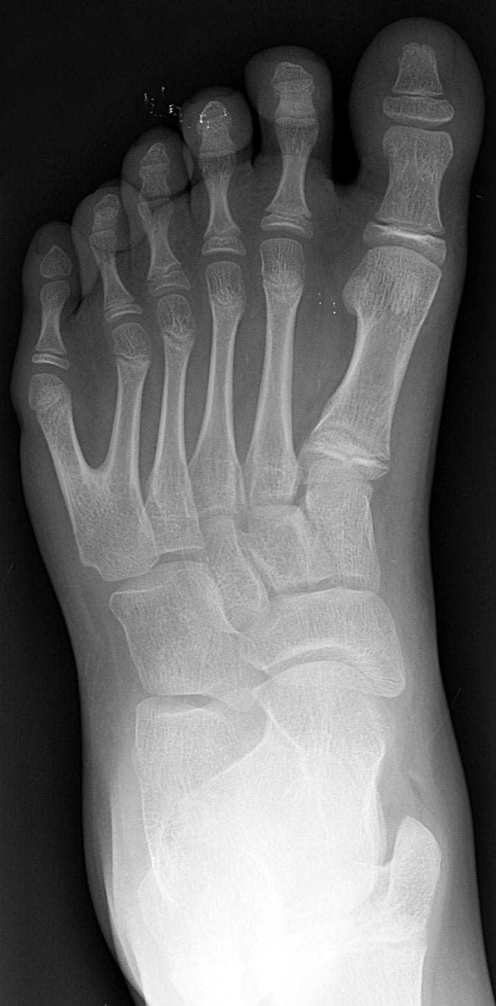 AP foot radiograph showing polydactyly with a duplicated ray and extra toe.