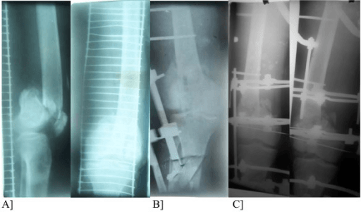 Three panels: a compound intra-articular distal femoral fracture, then a transarticular (knee-spanning) external fixator, then final conversion to an Ilizarov circular frame.