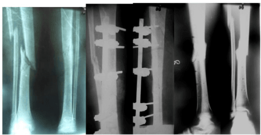 A Gustilo type IIIA open tibial fracture stabilised by an external fixator, continued to union.