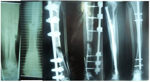 Type IIIb fracture of the tibia stabilized by an external fixator. The fracture was converted to an interlocking nail and the final result is shown.