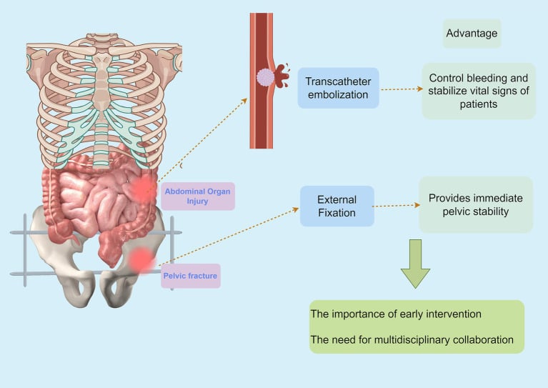 Schematic pairing transcatheter embolisation for abdominal organ injury with external fixation for pelvic fracture