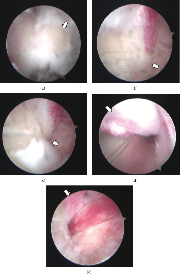 Posterior ankle arthroscopy showing os trigonum excision and FHL release