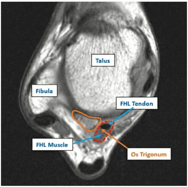 Axial MRI showing the os trigonum beside the flexor hallucis longus